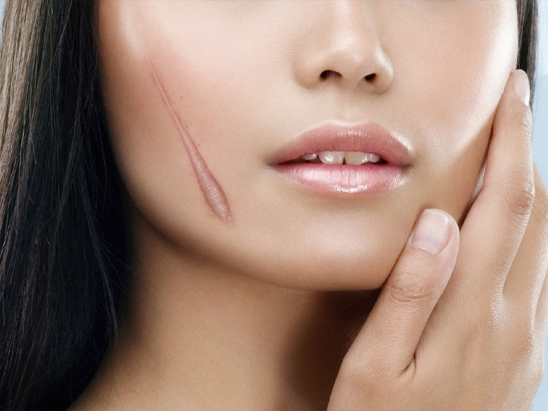 trị sẹo lồi bằng laser co2 fractional 2