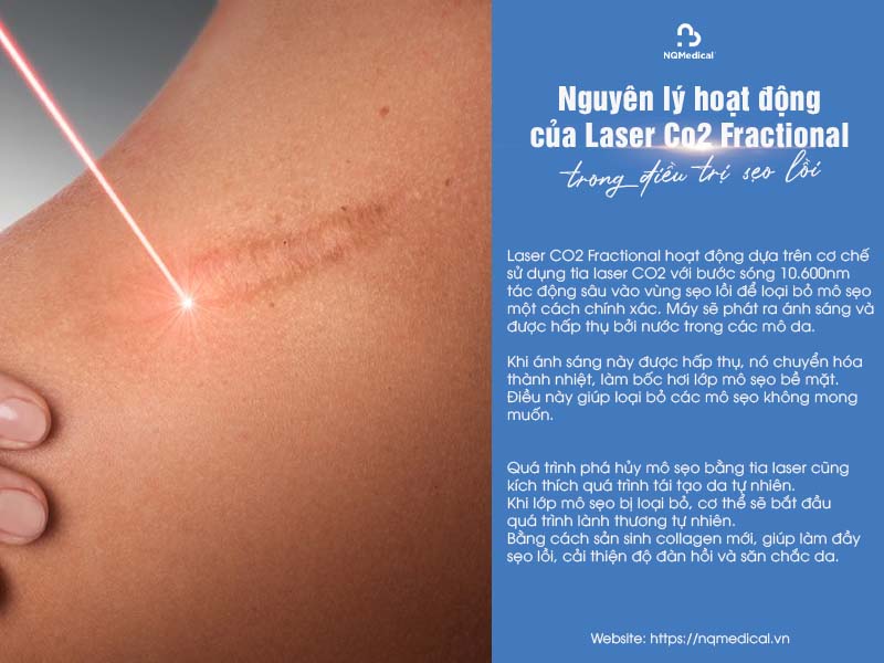 trị sẹo lồi bằng laser co2 fractional 3
