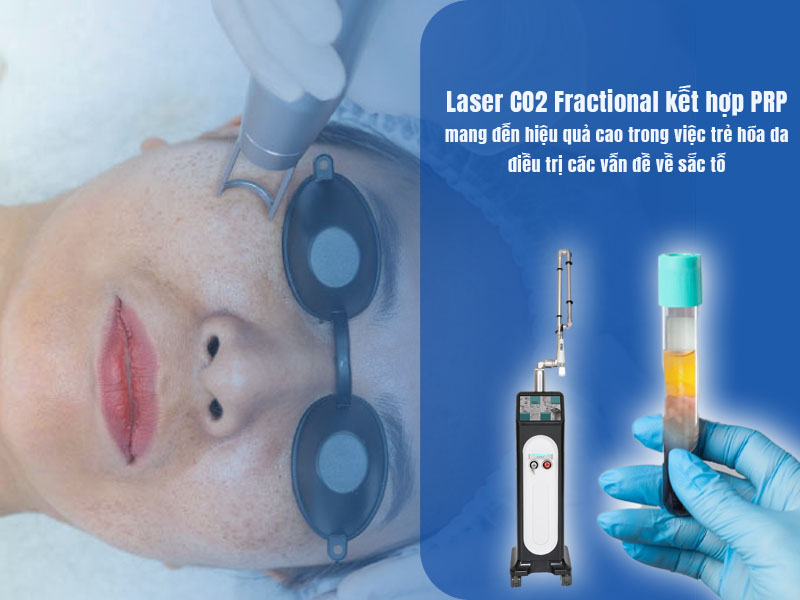 laser co2 fractional kết hợp prp 1