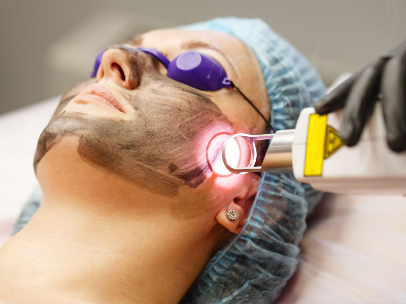 laser co2 fractional kết hợp prp 2