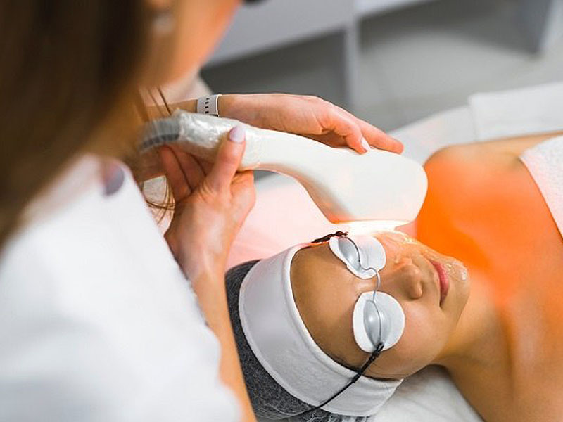 laser co2 fractional kết hợp prp 3