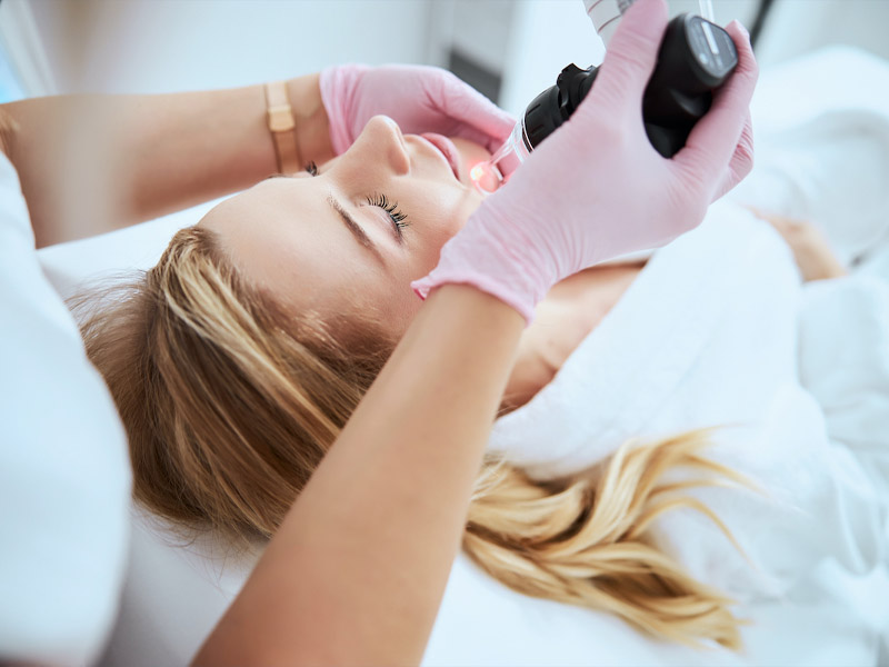 laser co2 fractional kết hợp prp 6