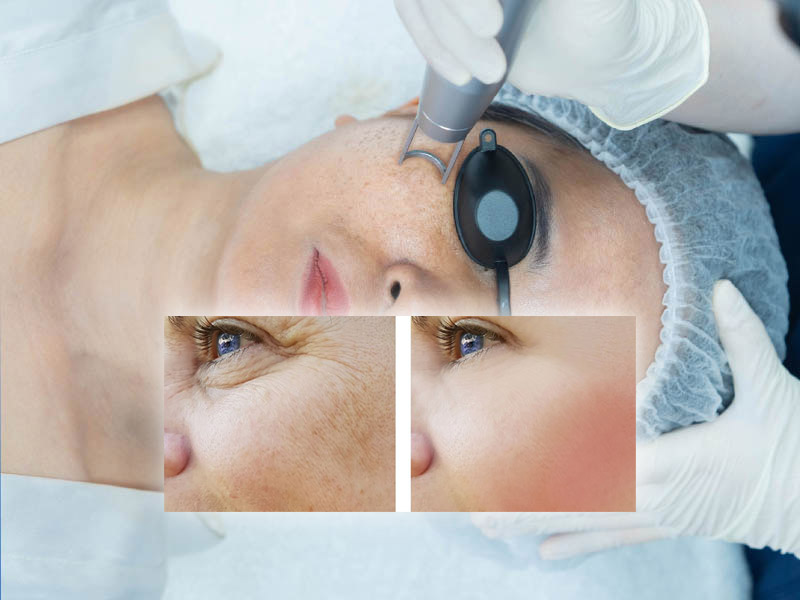 laser co2 fractional kết hợp prp 8
