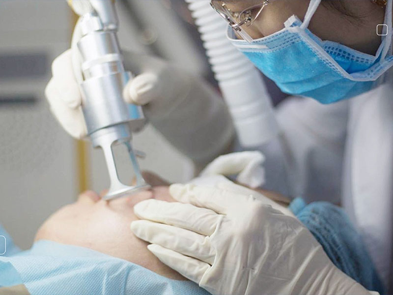 laser co2 fractional kết hợp prp 9