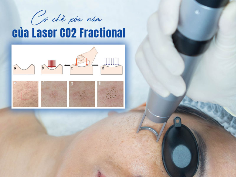 laser co2 fractional trị nám  3