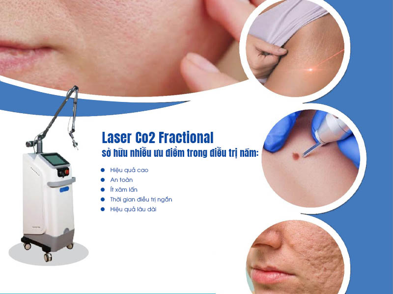 laser co2 fractional trị nám  4