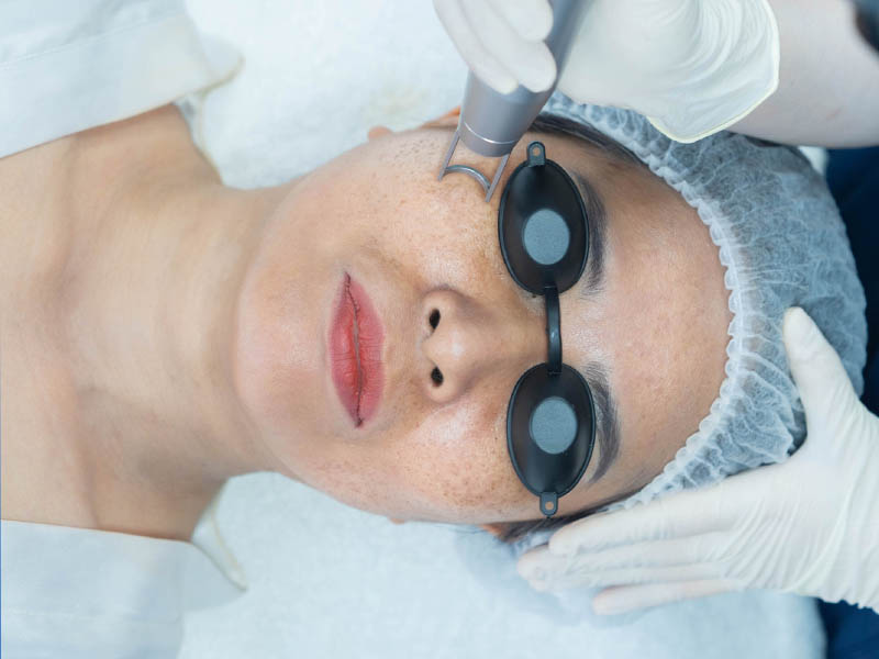 laser co2 fractional trị nám  8