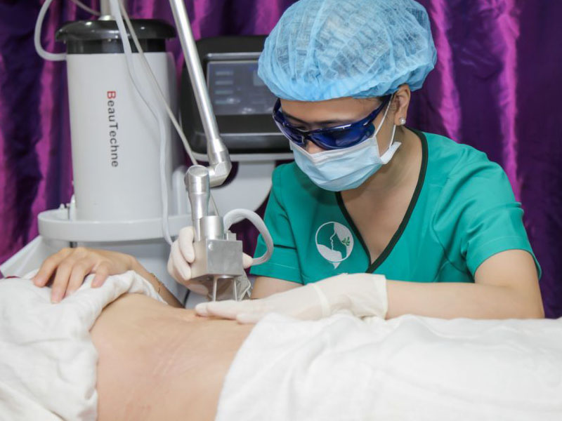 laser co2 fractional trị rạn da 4