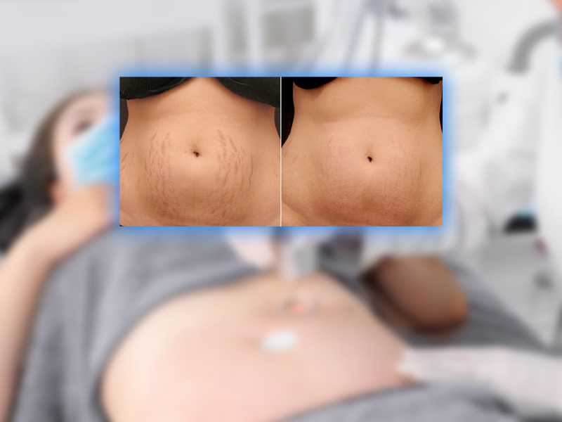laser co2 fractional trị rạn da 6