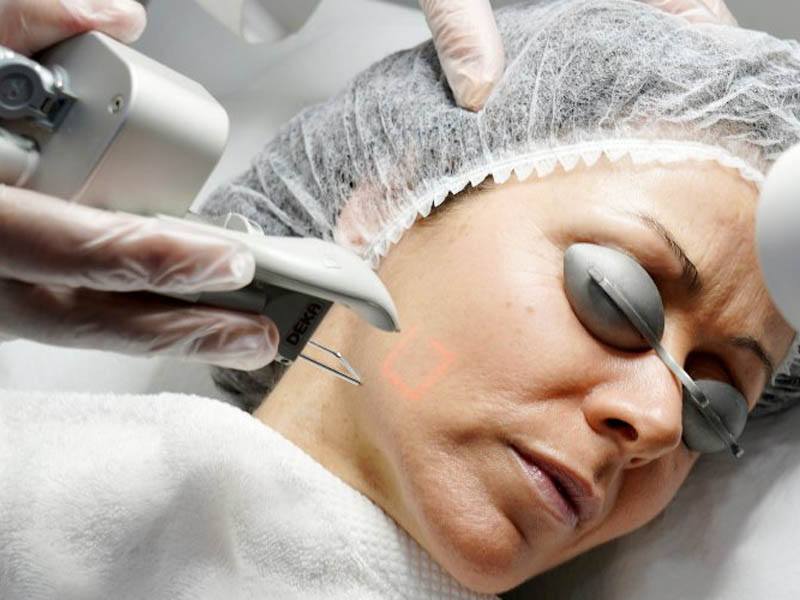 laser co2 fractional trị thâm 3