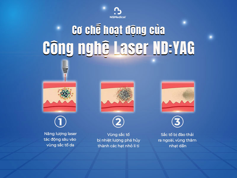 laser nd:yag 2