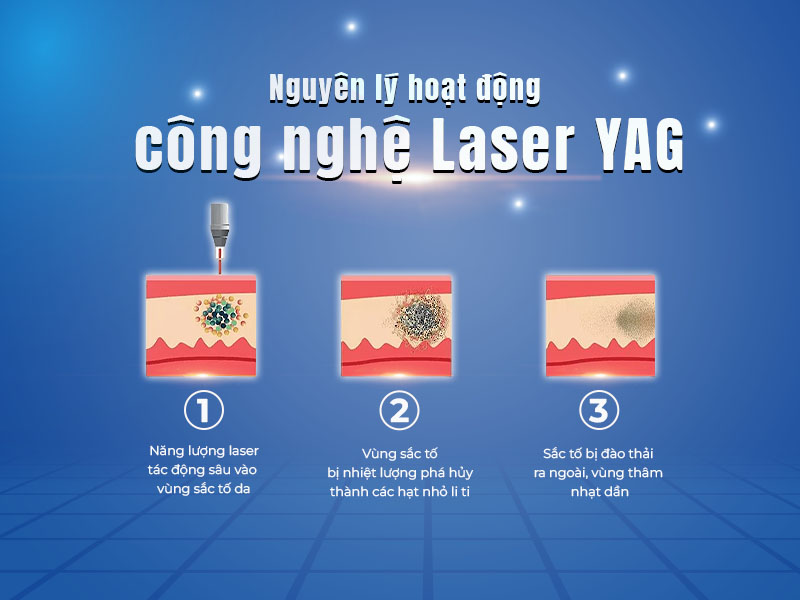 laser yag là gì 2