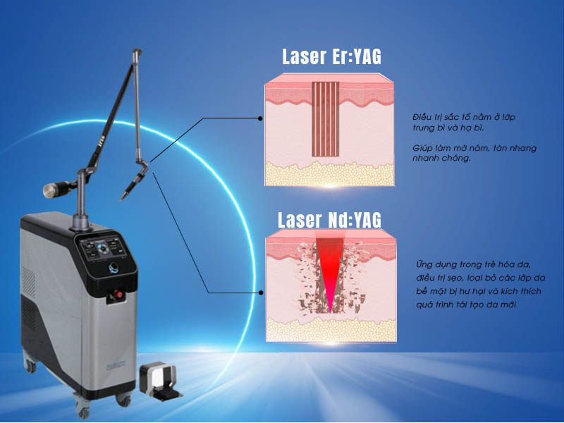 laser yag là gì 3