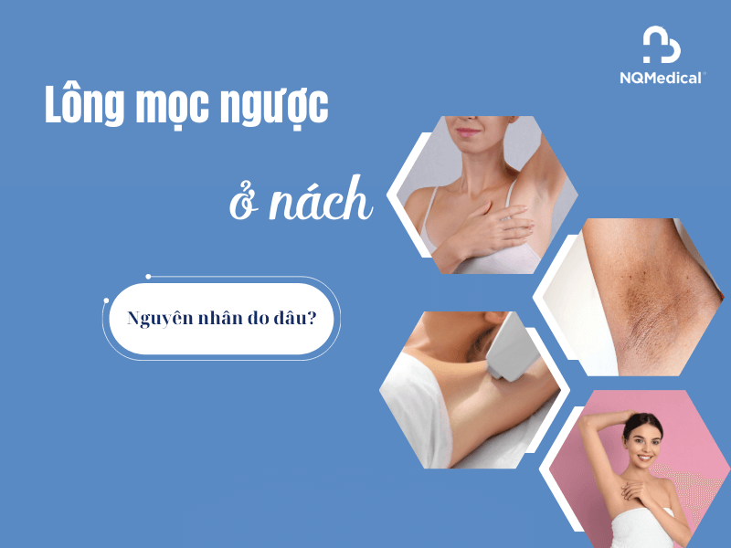 Lông mọc ngược ở nách - 8
