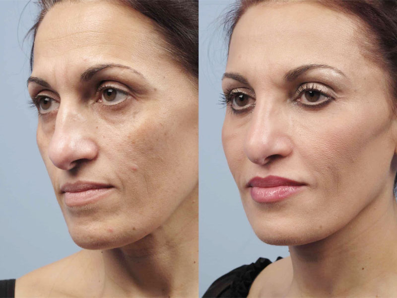 máy fractional co2 laser 7