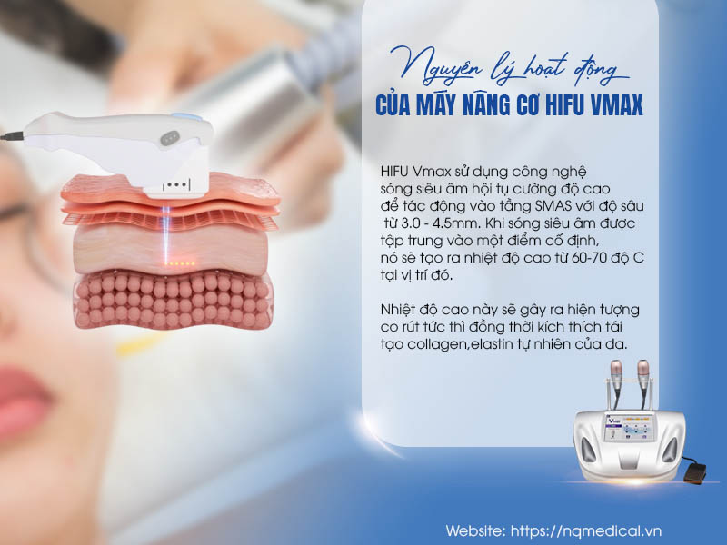 Máy Nâng Cơ Hifu V-MAX - 1