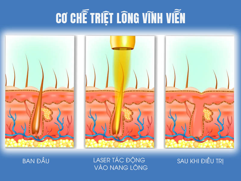 so sánh công nghệ triệt lông diode laser và ipl 1