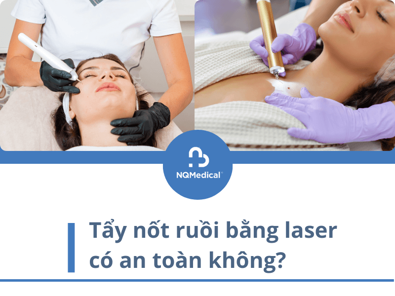Tẩy nốt ruồi bằng laser có đau không -6