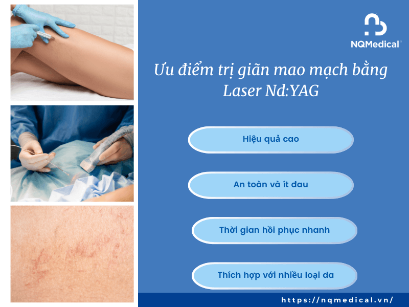 Trị giãn mao mạch bằng Laser Nd YAG -4