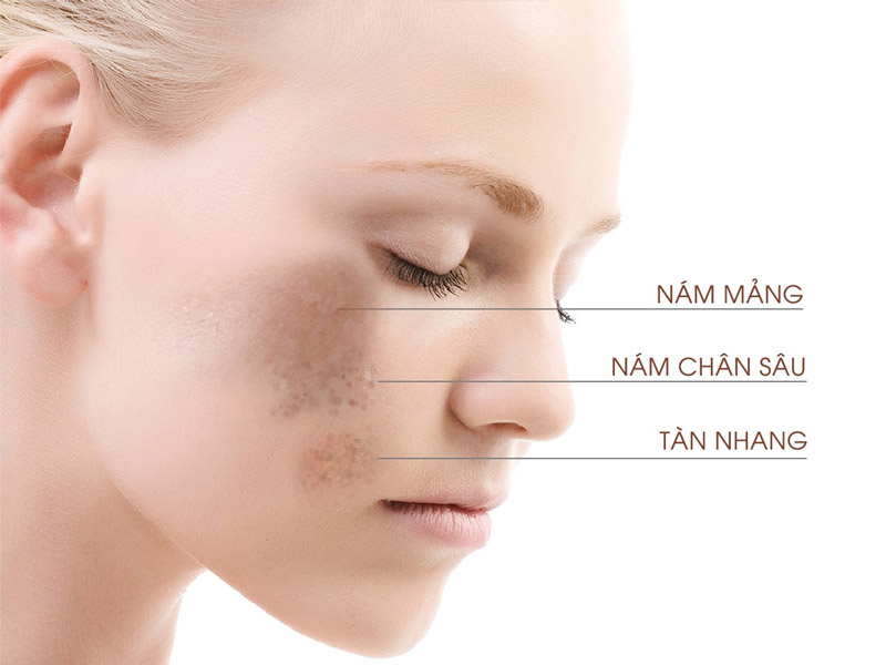 trị nám bằng công nghệ laser nd yag 1