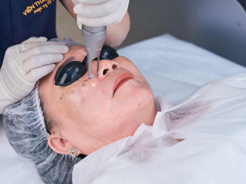 trị tàn nhang bằng laser nd yag 2