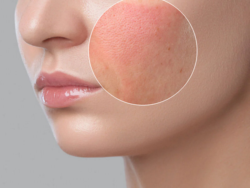 trị tàn nhang bằng laser nd yag 7