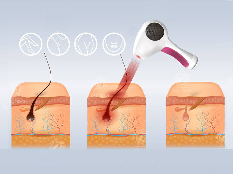 triệt lông bằng diode laser có tốt không 1