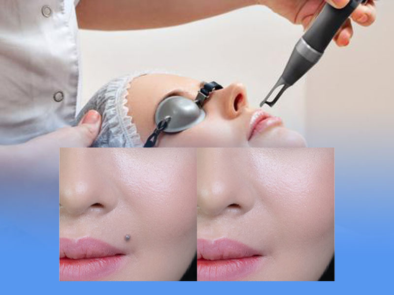 xóa nốt ruồi bằng laser co2 fractional 10
