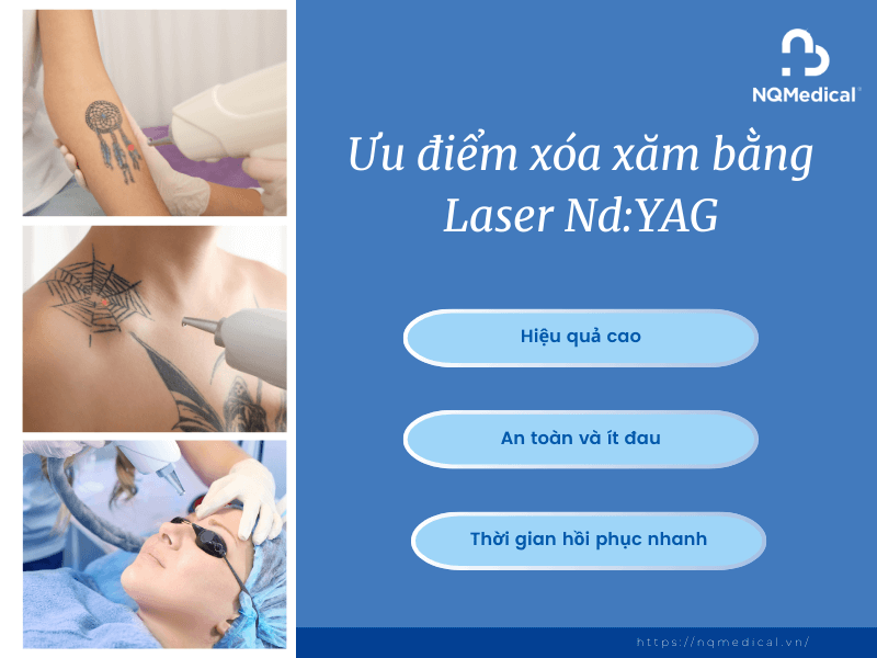 Xóa Xăm Bằng Laser Nd YAG - 3