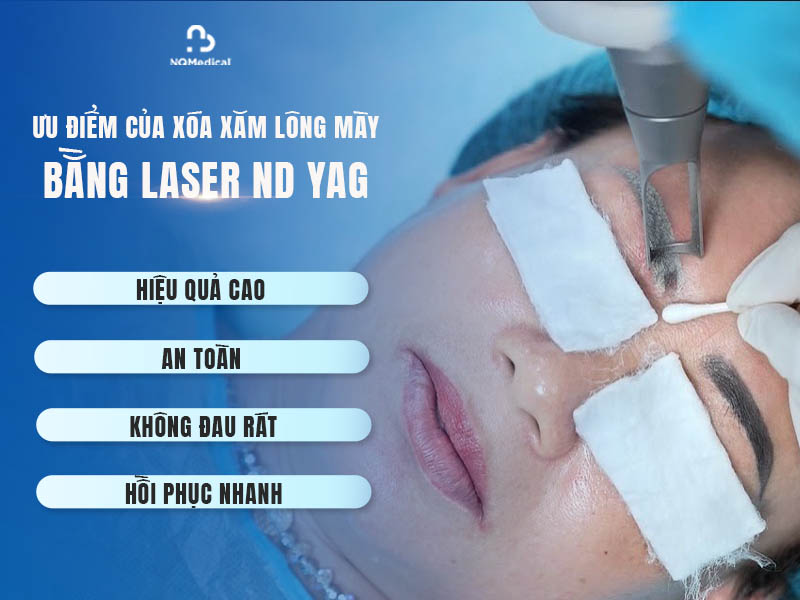xóa xăm lông mày bằng laser nd yag 2