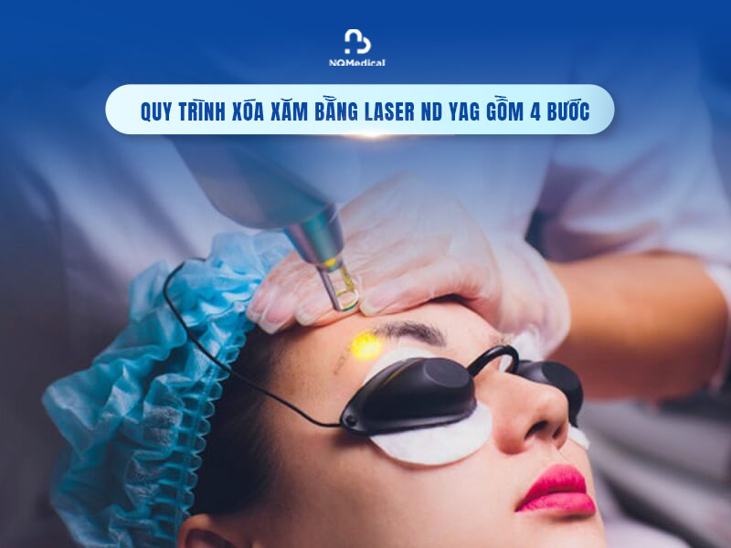 xóa xăm lông mày bằng laser nd yag 3