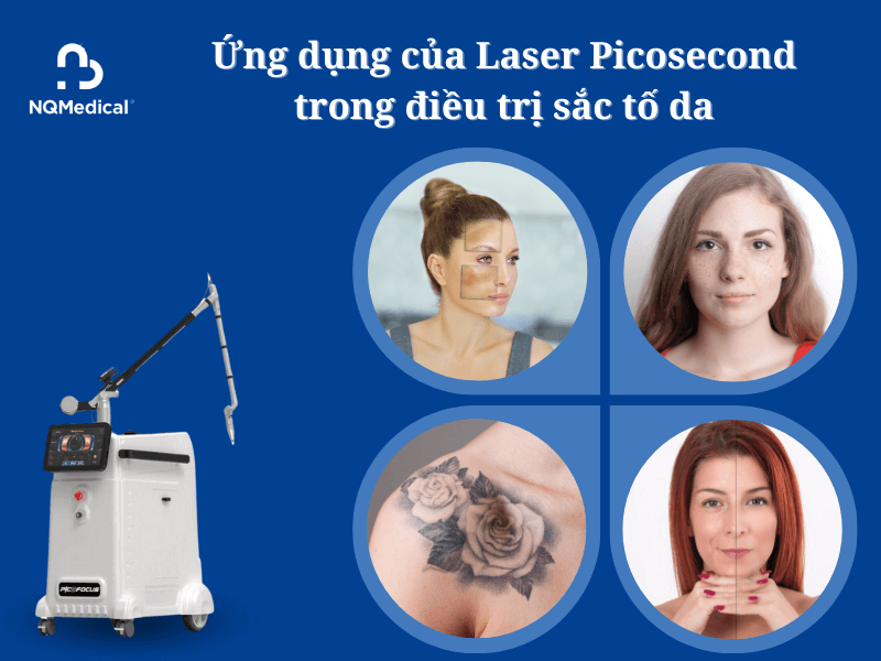 Điều trị sắc tố Picosecond Laser - 5