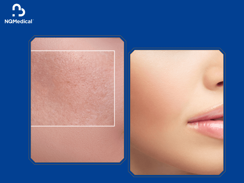 trẻ hóa da bằng Laser Toning - 2