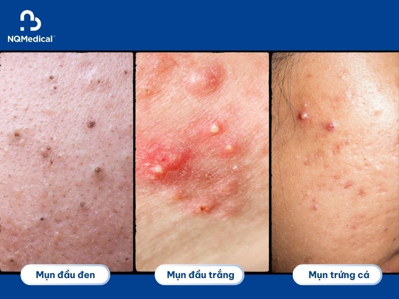 Trị mụn bằng Laser Carbon -2