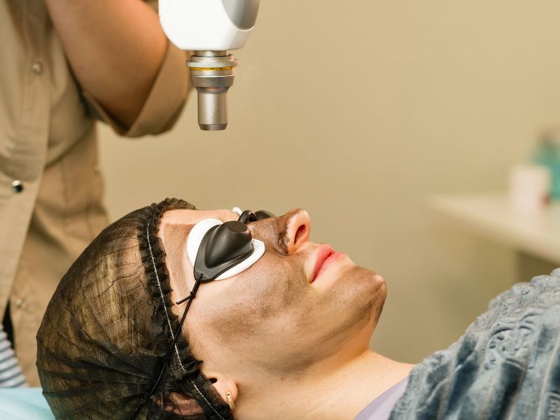 Trị mụn bằng Laser Carbon - 4