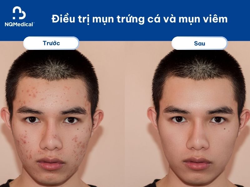 Trị mụn bằng Laser Carbon -5