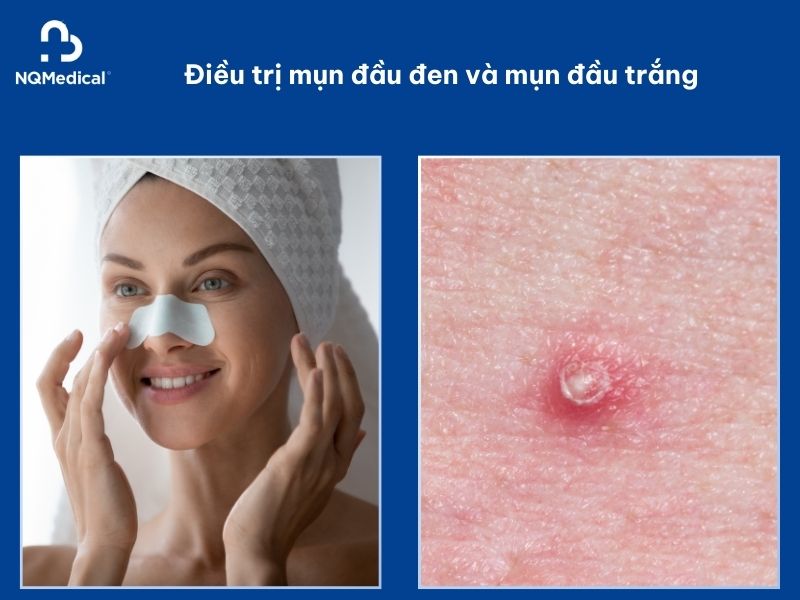Trị mụn bằng Laser Carbon -6