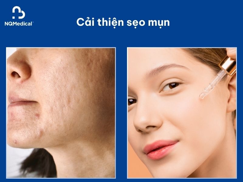 Trị mụn bằng Laser Carbon -7