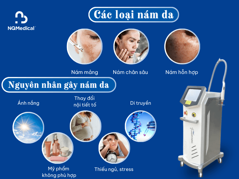 trị nám bằng công nghệ laser toning -2