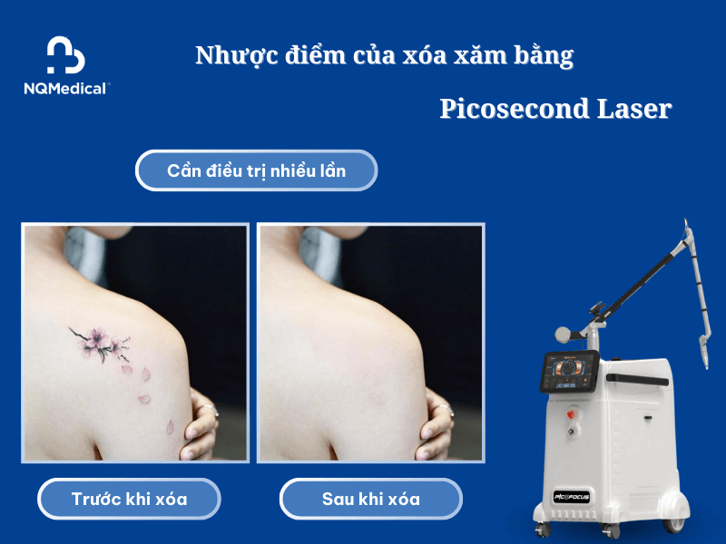 Xóa xăm bằng Laser Picosecond - 4