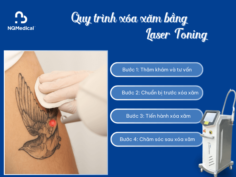 xóa xăm bằng laser toning -4