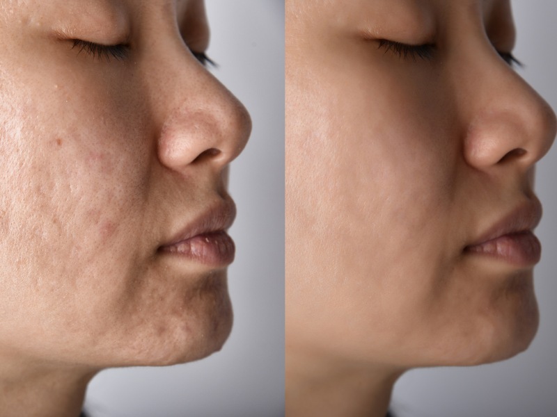 chăm sóc da sau laser trị nám - 4