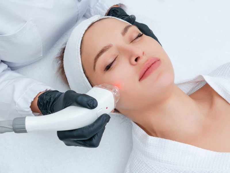 Có nên bắn laser trị tàn nhang - 4