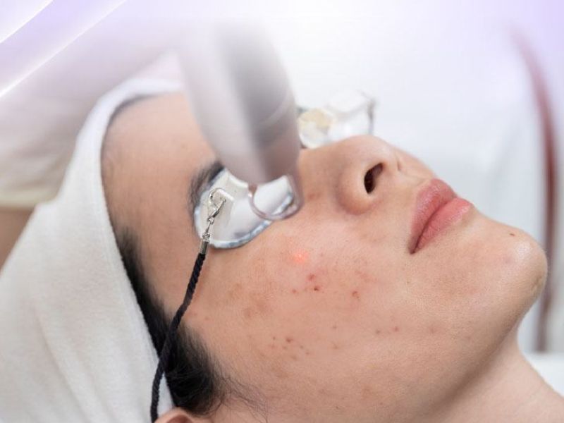 Điều trị mụn trứng cá bằng laser - 12
