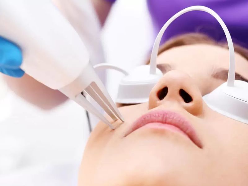 Điều trị mụn trứng cá bằng laser - 3