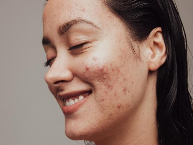 Điều trị mụn trứng cá bằng laser - 2