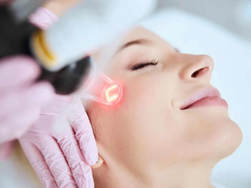 Điều trị mụn trứng cá bằng laser - 4