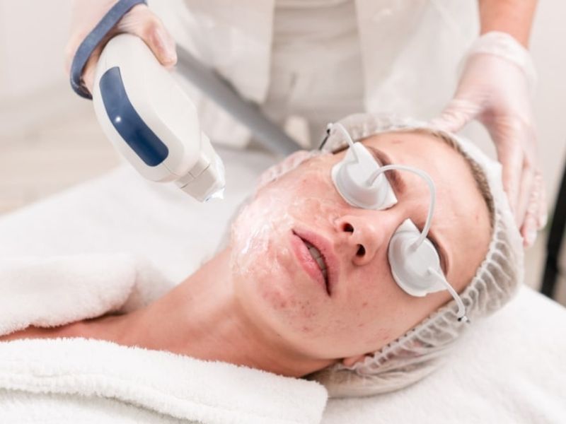 Điều trị mụn trứng cá bằng laser - 7