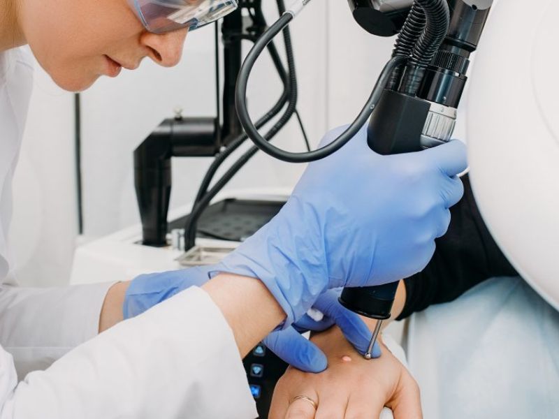 Đốt laser mụn cóc bao lâu thì lành - 1