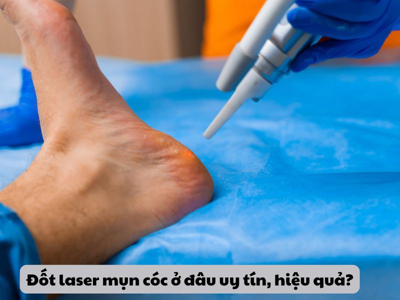 Đốt laser mụn cóc ở đâu - 1 Đốt laser mụn cóc ở đâu - 1